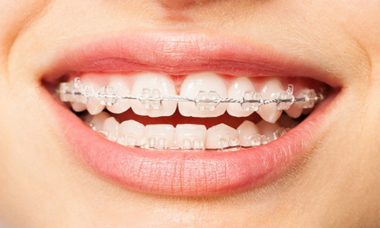 Fixed orthodontic ceramic