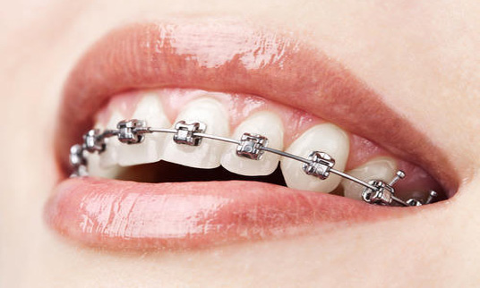 fixed orthodontic metal