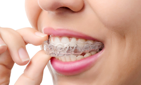 Invisalign