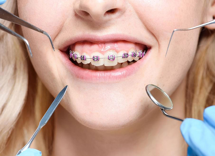 Orthodontic Treatment