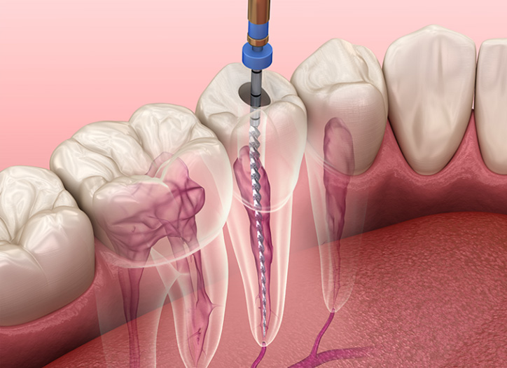 Root Canal Treatment